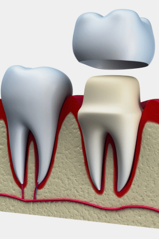 Dental Crowns Dental Clinic in Fergus ON 226-897-1016