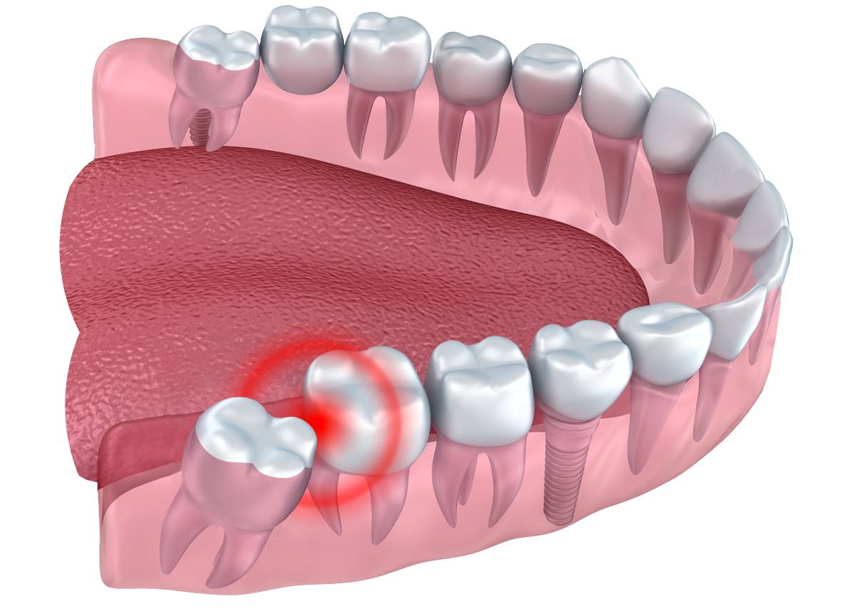 Wisdom Teeth Removal by Crystal Dental Clinic in Fergus